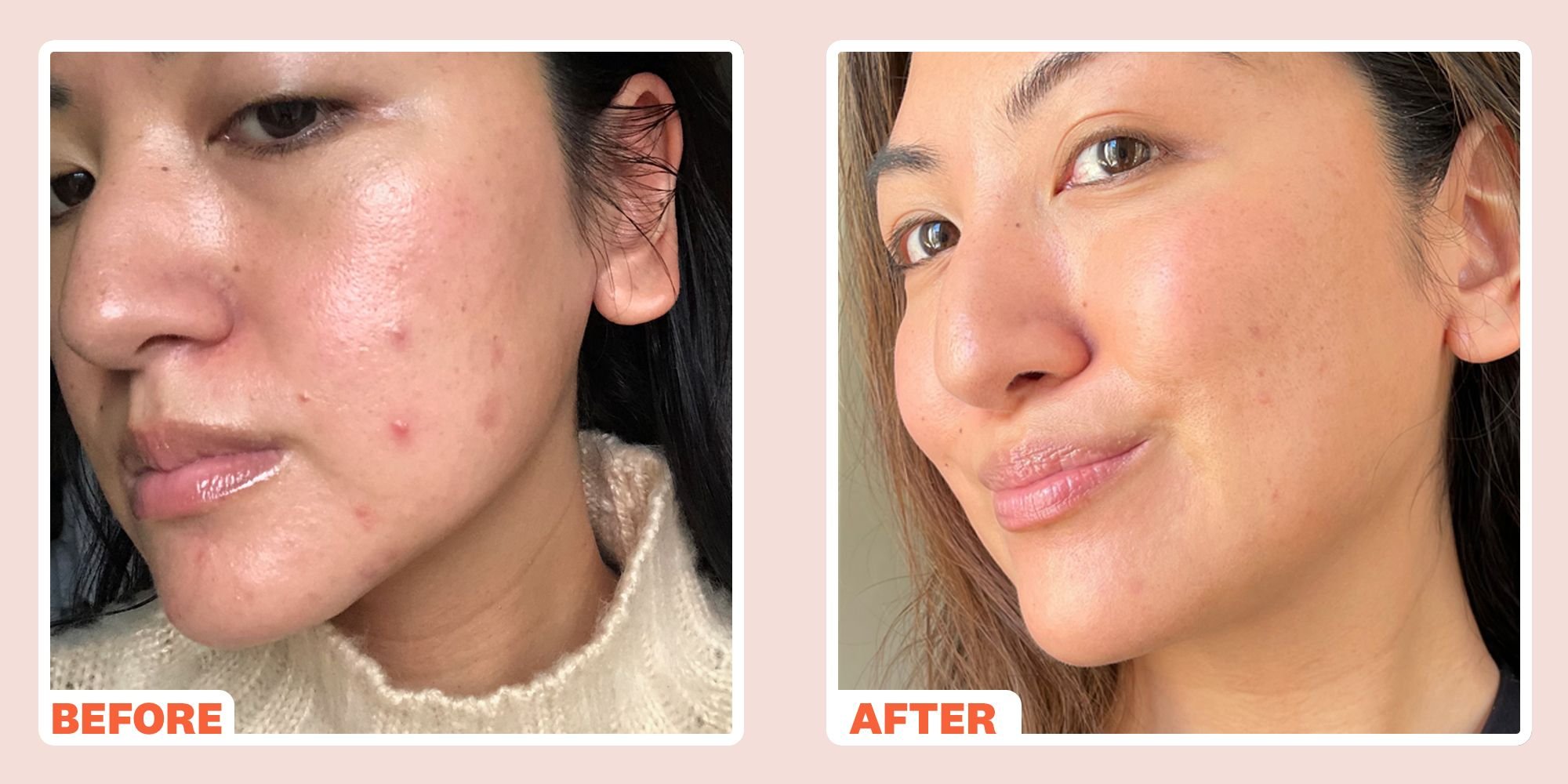 wh-index-beauty-beforeandafter-kr-microneedling-1614789818.jpeg