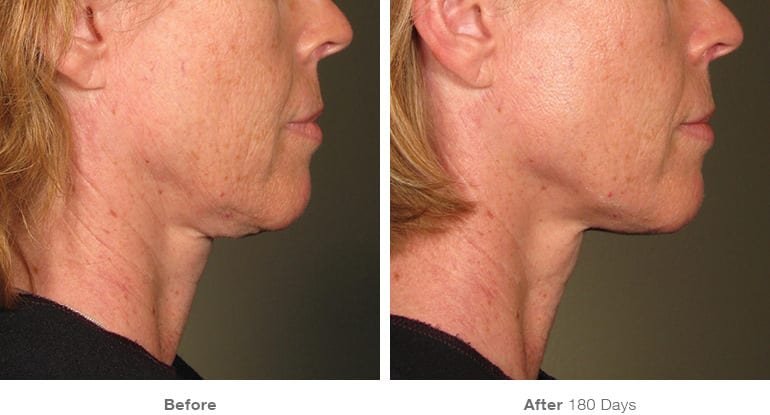 before_after_ultherapy_results_under-chin16.jpeg