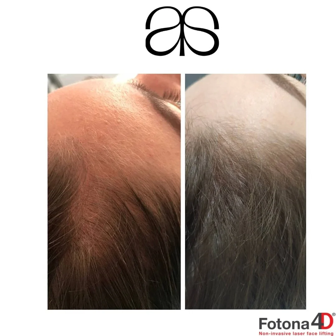 Say goodbye to thinning hair with the incredible Fotona hair restoration laser treatment! ⁠
⁠
💎No downtime!⁠
💎No pain!⁠
💎No injection!⁠
⁠
Check out these amazing before and after results that speak for themselves. ⁠
⁠
Book a consultation with us a