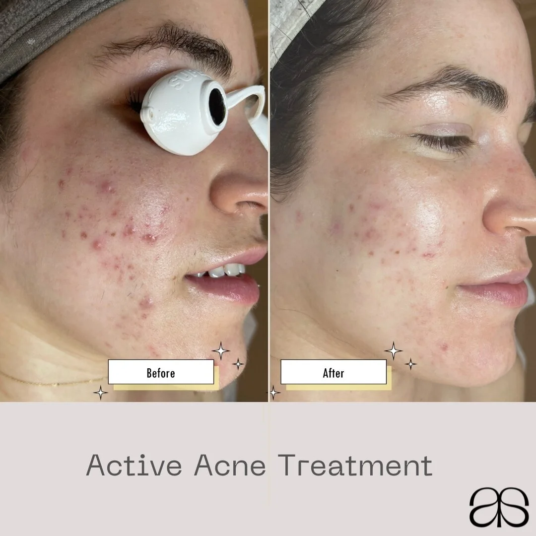 No extractions! No harsh peels!  To reach clear and health Skin. ⁠
⁠
Benefits of Fotona Laser Treatment:⁠
⁠
💎 Target overactive sebaceous glands⁠;⁠
⁠
💎 Reduce the risk of developing new acne inflammation⁠;⁠
⁠
💎 Improving the appearance of acne sca