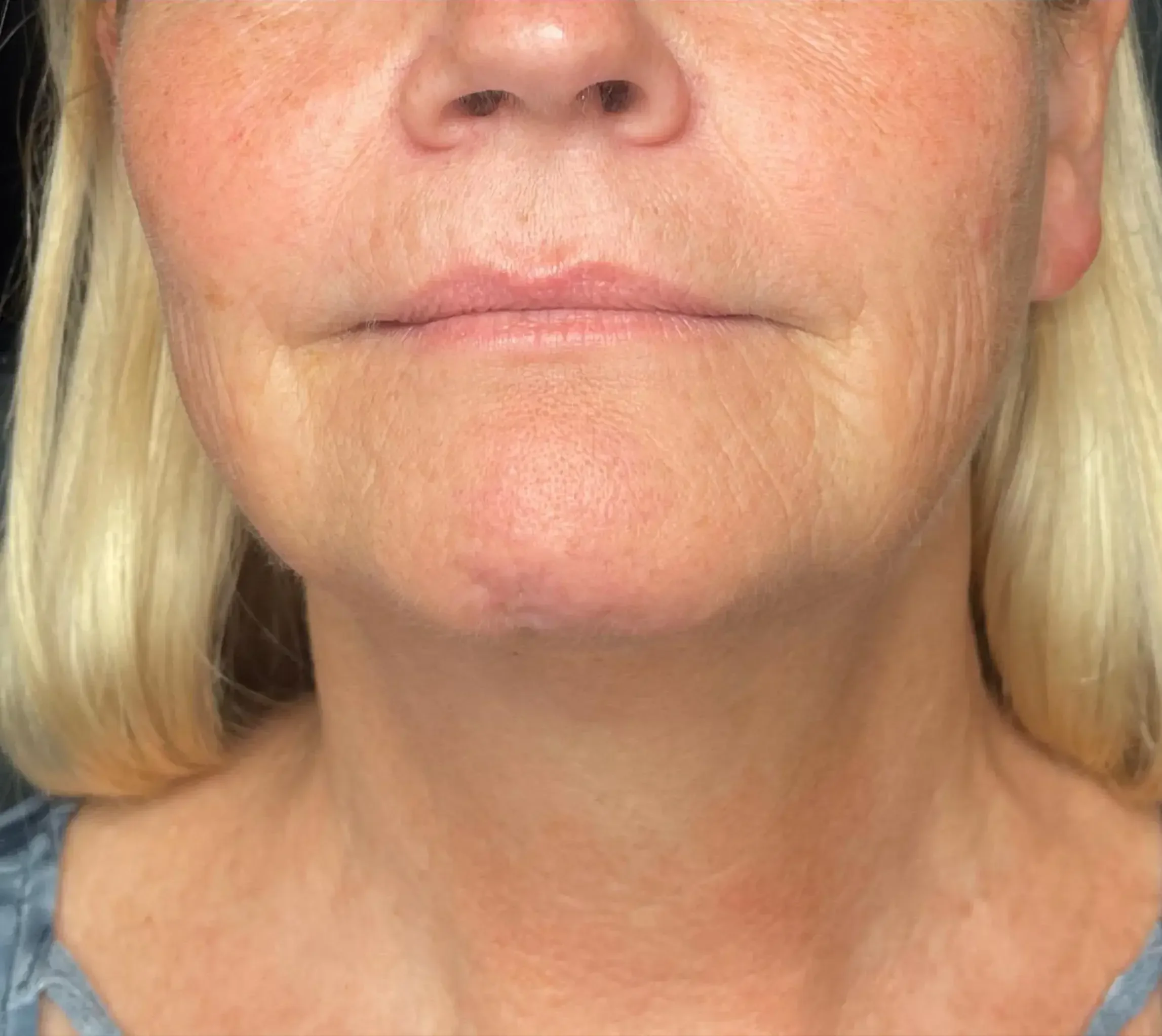 2_Innovative Beauty_Neck_After.webp