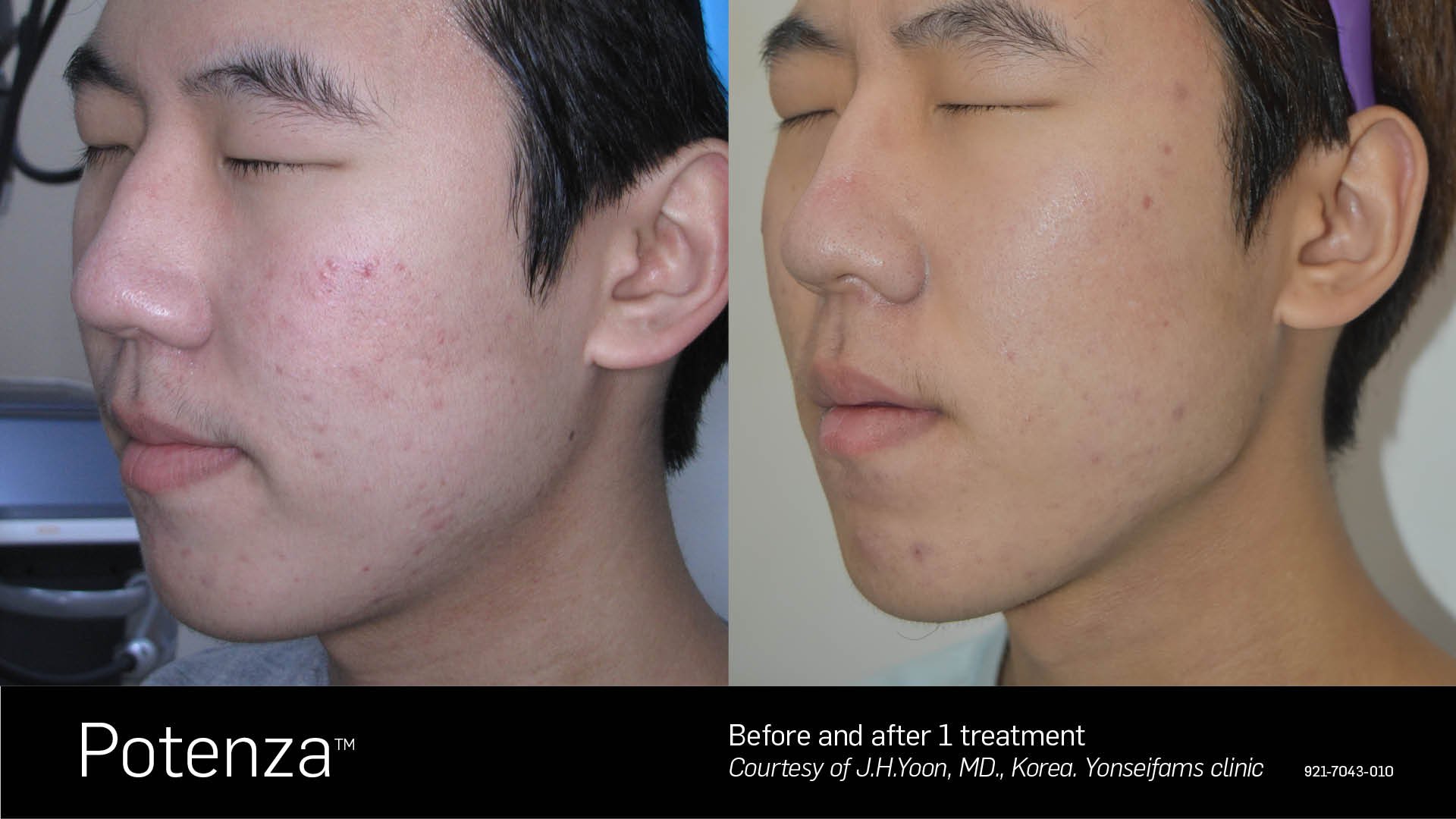 rf-microneedling-before-and-after-Toronto-ON.jpg