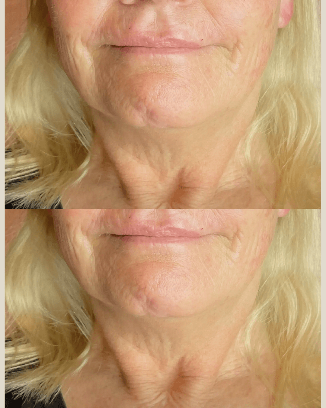 anso density-neck.png