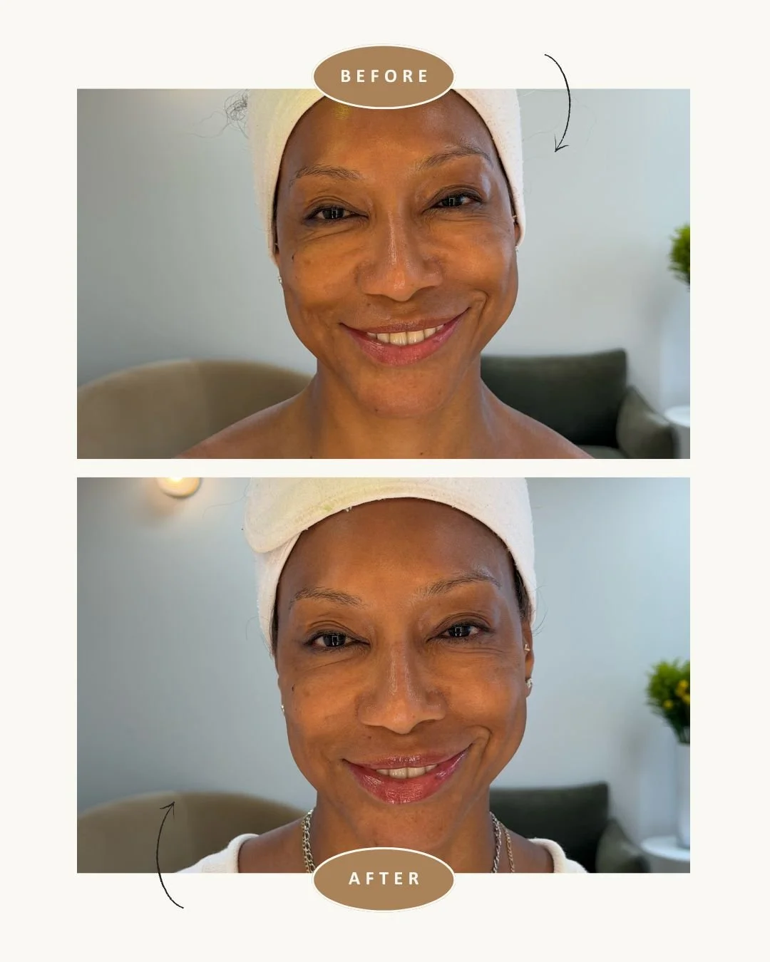 anso-med-spa-nyc-fotona-lip-laser-before-after1.jpg
