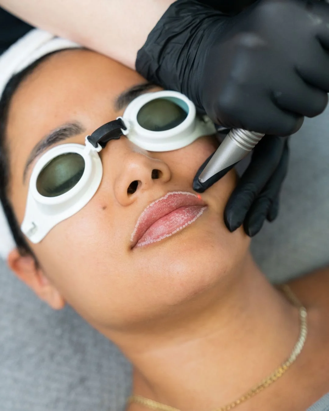 anso-med-spa-nyc-lip-laser-treatment-fotona.jpg