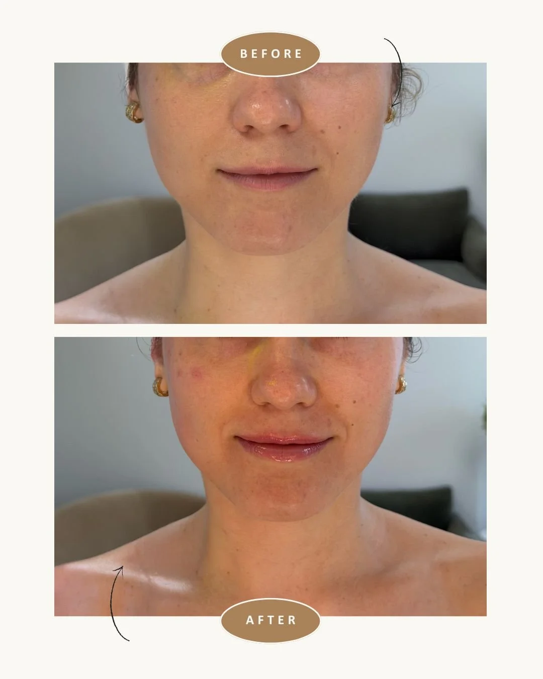anso-med-spa-nyc-fotona-lip-laser-before-after3.jpg