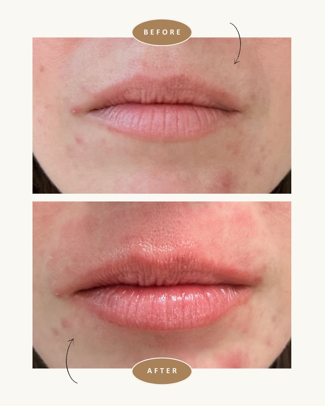 anso-med-spa-nyc-fotona-lip-laser-before-after7.jpg