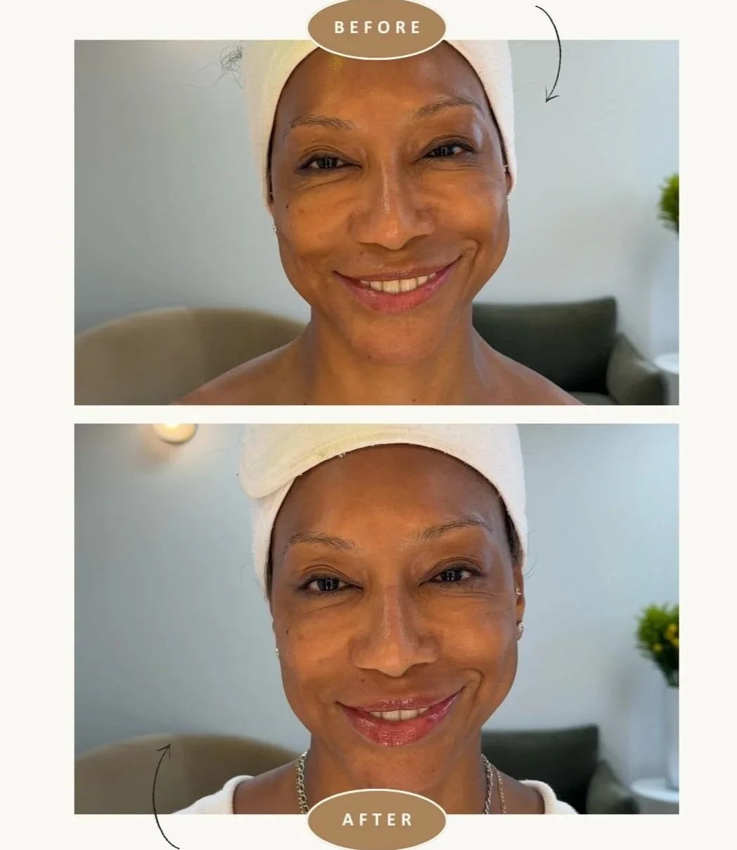 anso-med-spa-nyc-fotona-lip-laser-before-after1.jpg