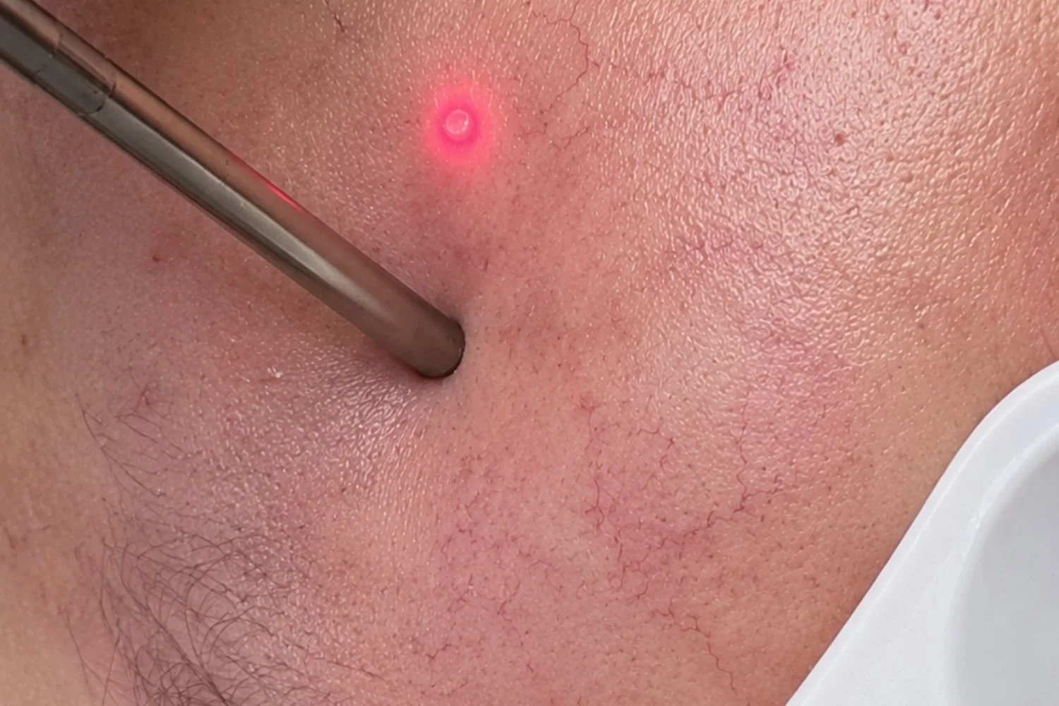 anso-med-spa-fotona-smooth-spider-vein-removal-laser-nyc.jpg