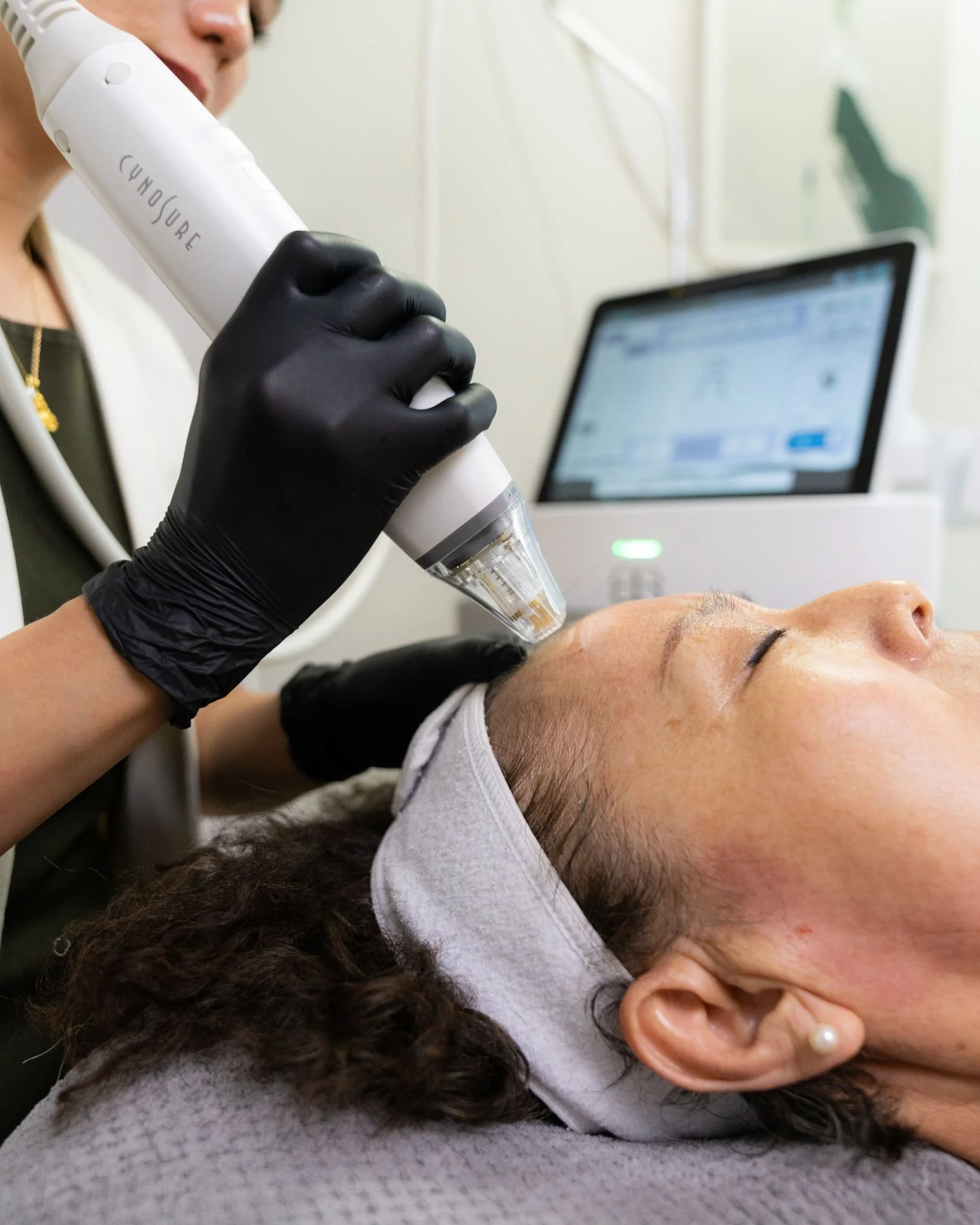 potenza rf microneedling face treatment