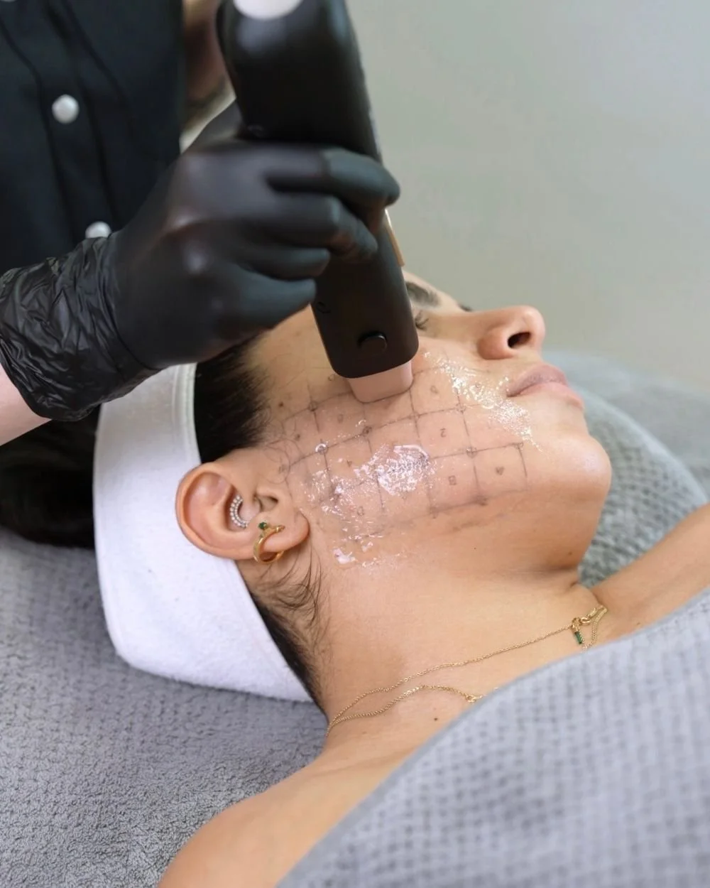 Facial treatments at ANSO Med Spa, Koreatown NYC — Density RF Facelift treatment