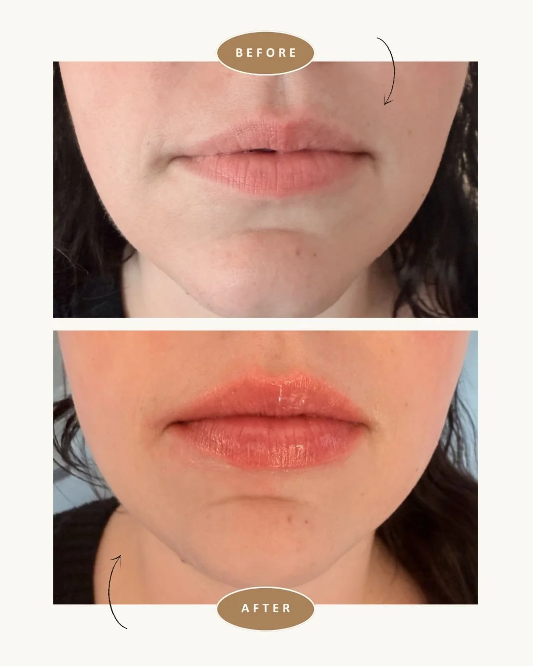 anso-med-spa-nyc-fotona-lip-laser-before-after4.jpg