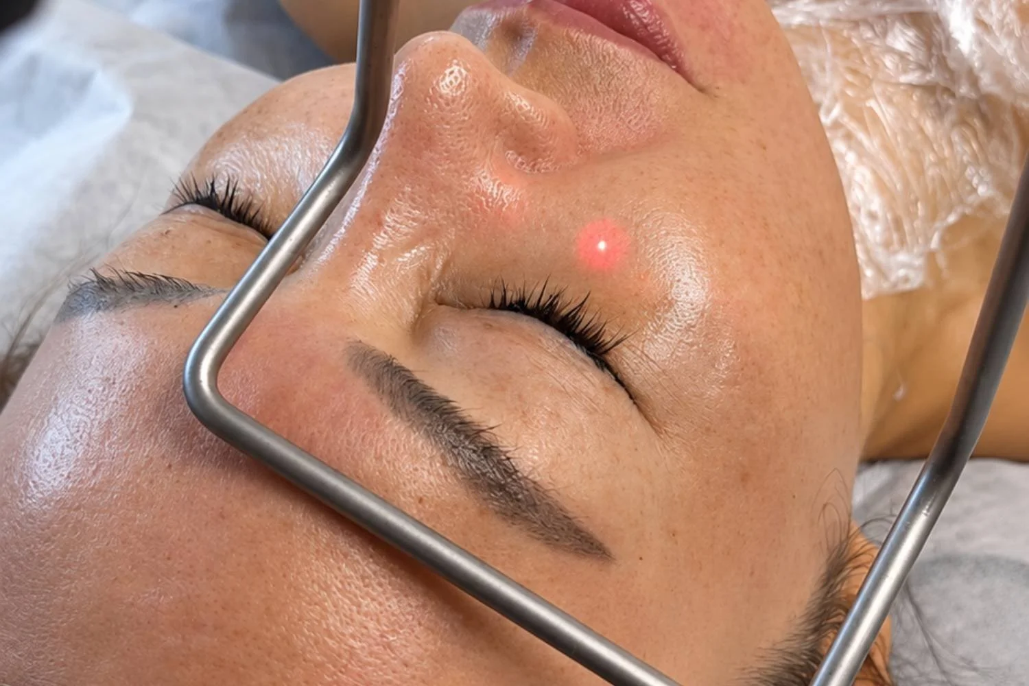 Fotona 4D smooth eye and neck laser treatment at ANSO Med Spa Koreatown NYC