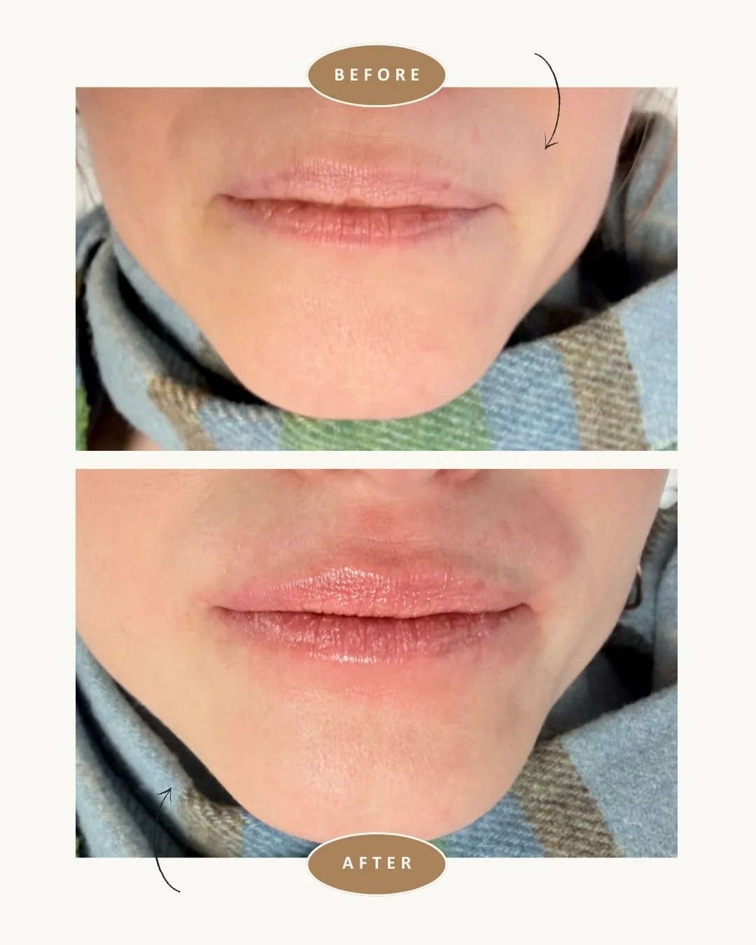 anso-med-spa-nyc-fotona-lip-laser-before-after6.jpg
