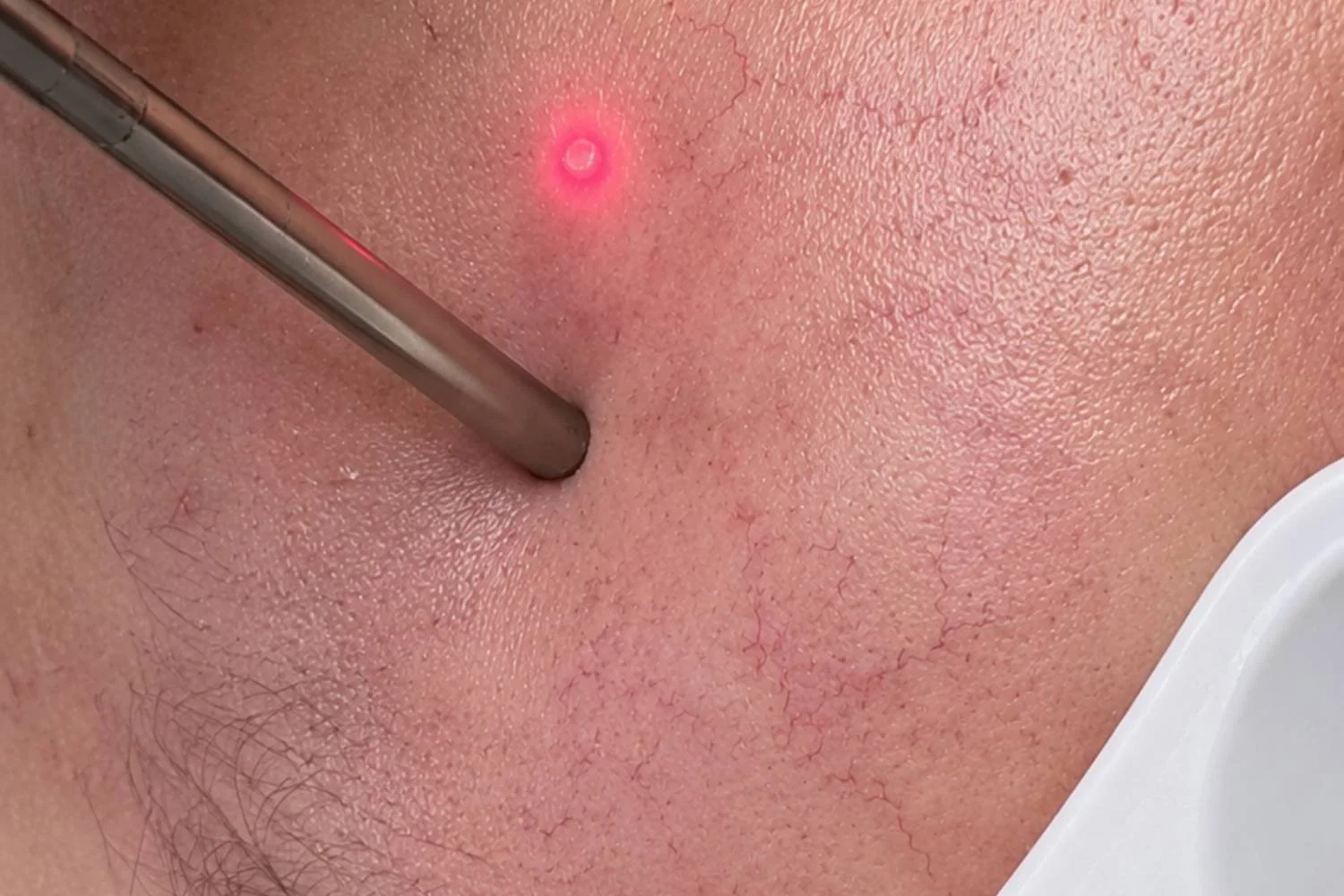 Fotona laser spider vein skin tag and mole removal at ANSO Med Spa NYC