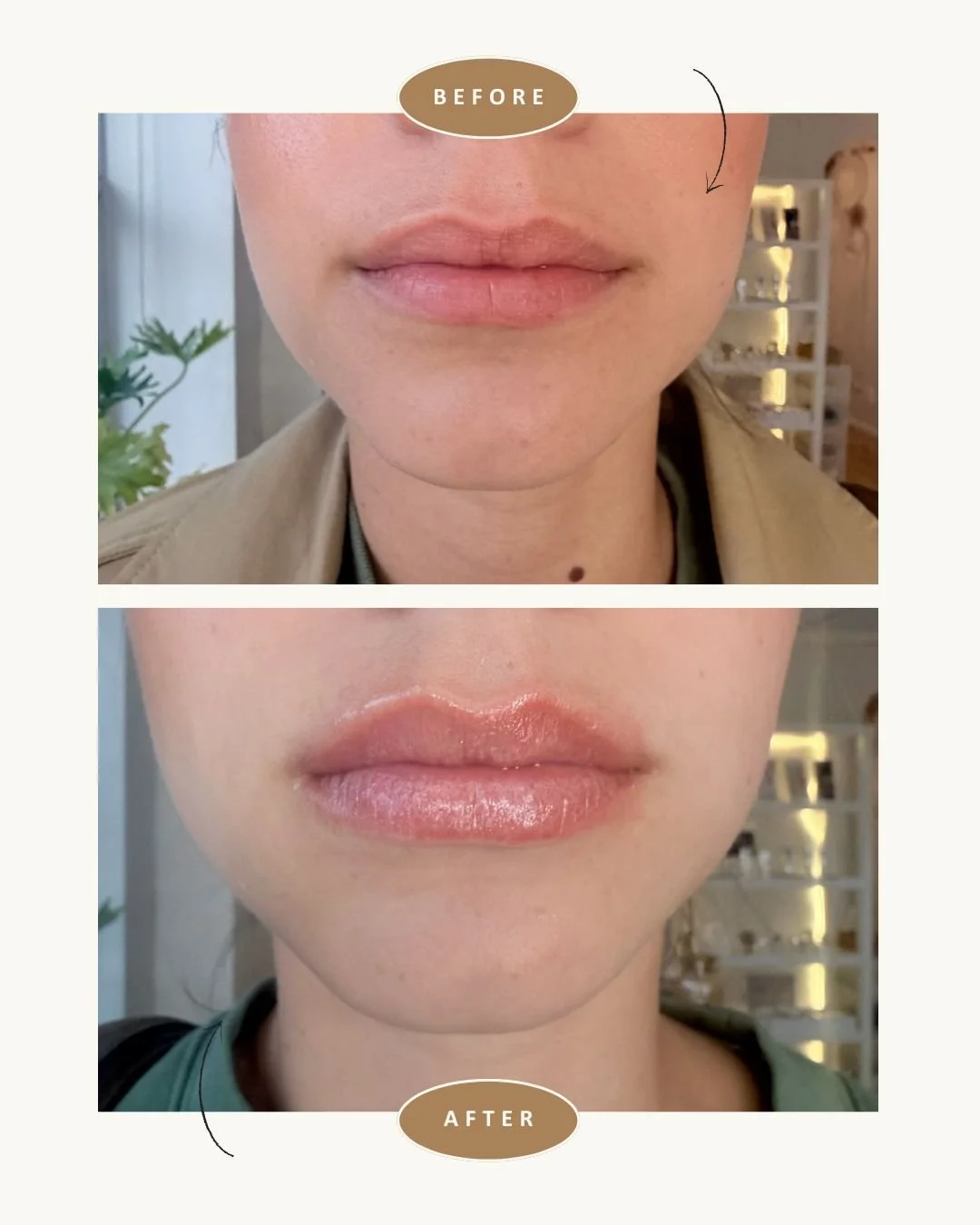 anso-med-spa-nyc-fotona-lip-laser-before-after5.jpg