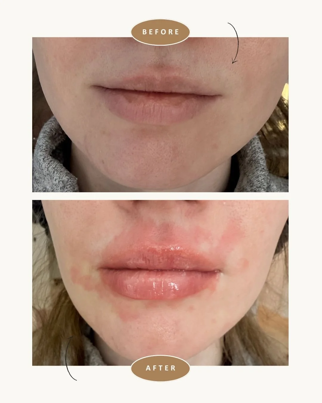 anso-med-spa-nyc-fotona-lip-laser-before-after2.jpg