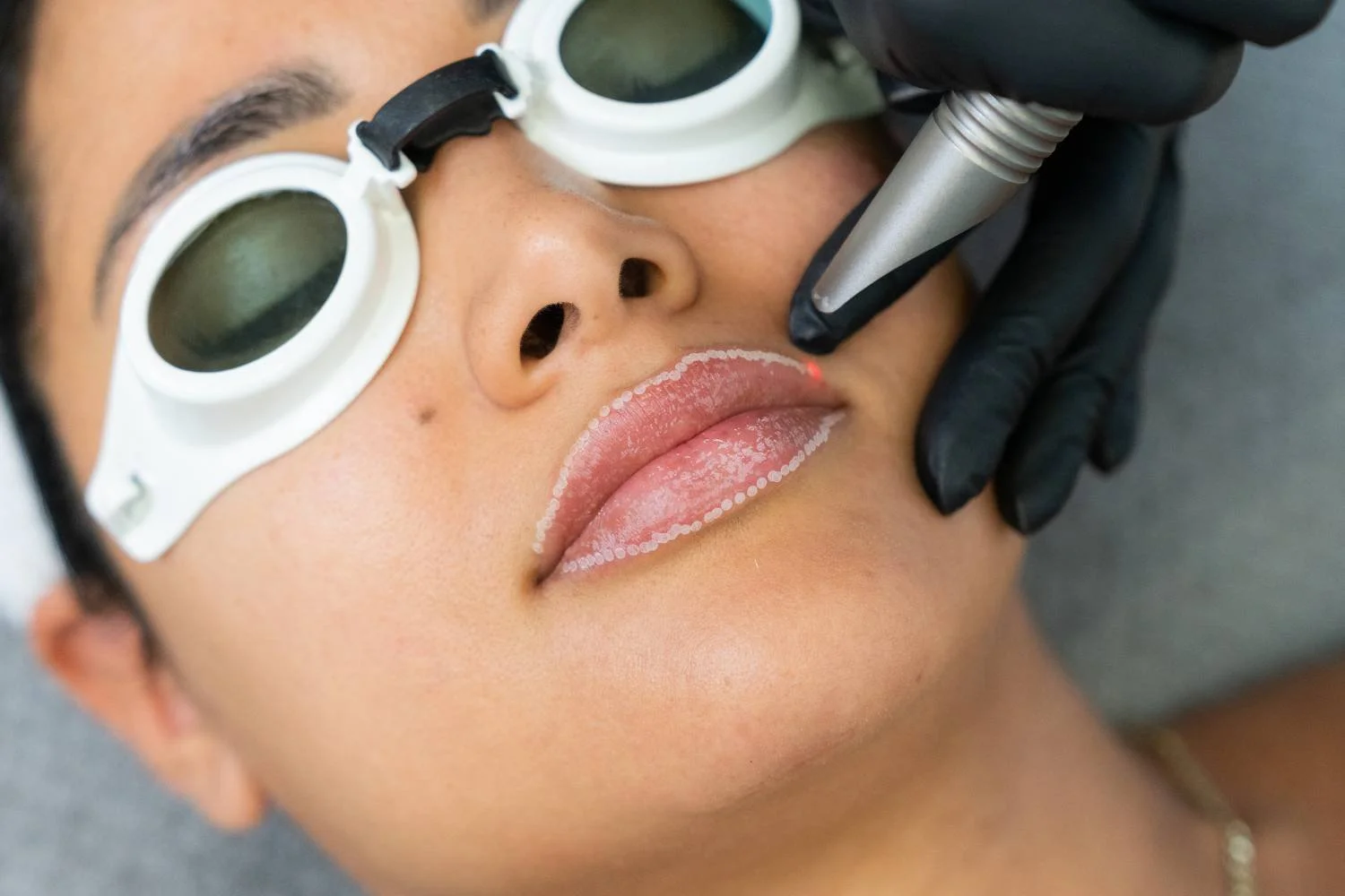 Fotona 4D LipLase lip laser treatment at ANSO Med Spa Koreatown NYC