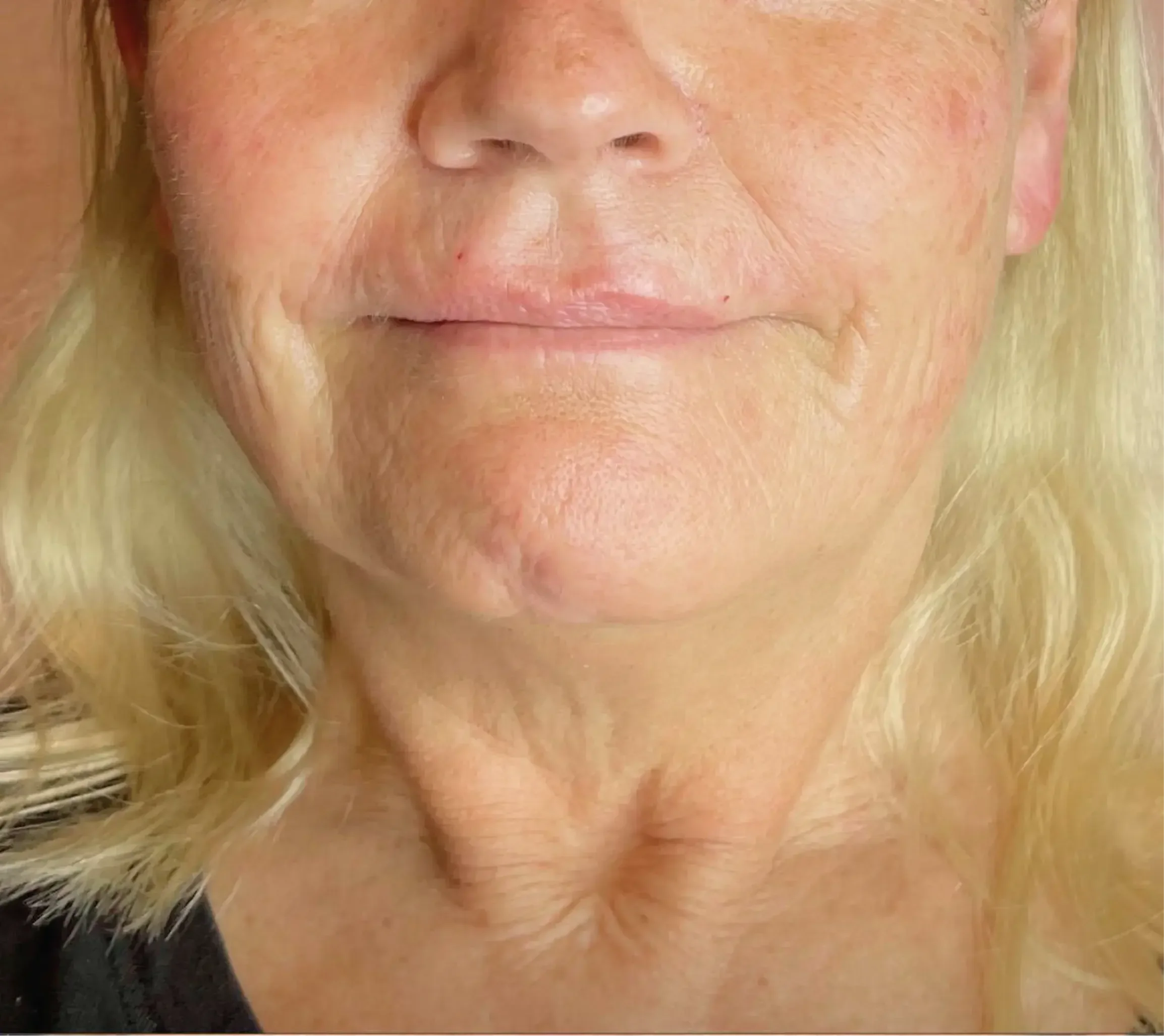 2_Innovative Beauty_Neck_Before.webp