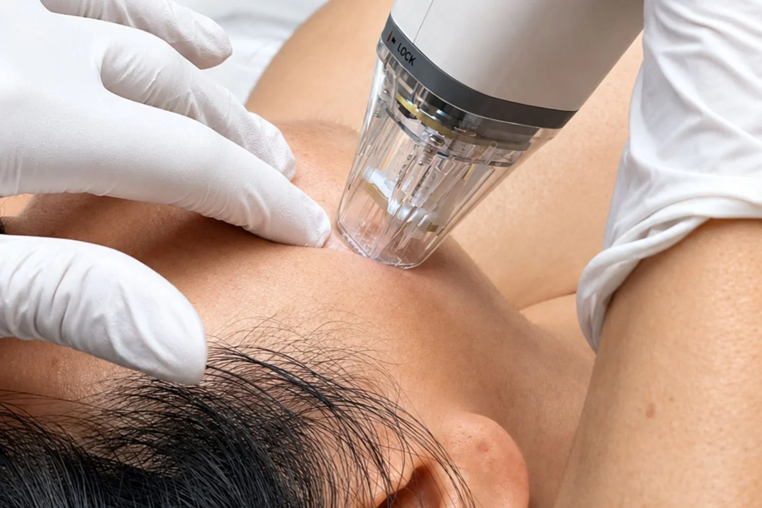 Anso Med Spa Diamond Membership Potenza Fotona Rejuran