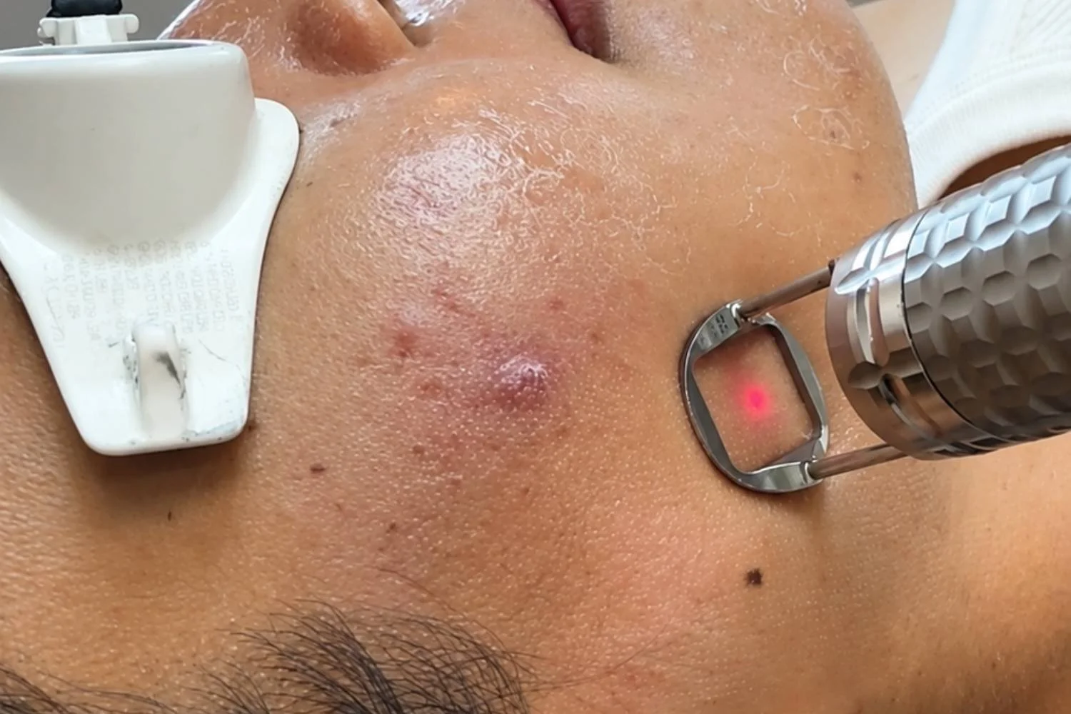 Fotona 4D active acne and scar laser treatment at ANSO Med Spa Koreatown NYC