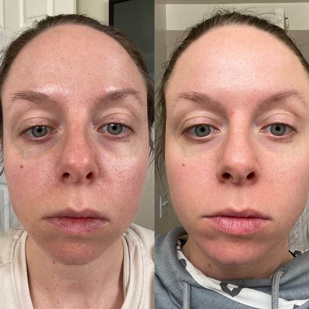 Great skin doesn&rsquo;t happen by chance, it happens by appointment! I&rsquo;m so thrilled with these two week results on beautiful @megmarinangeli 😍

Oil is controlled. Pores are shrinking. Hyperpigmentation is fading. Dark circles GONE. Face plum