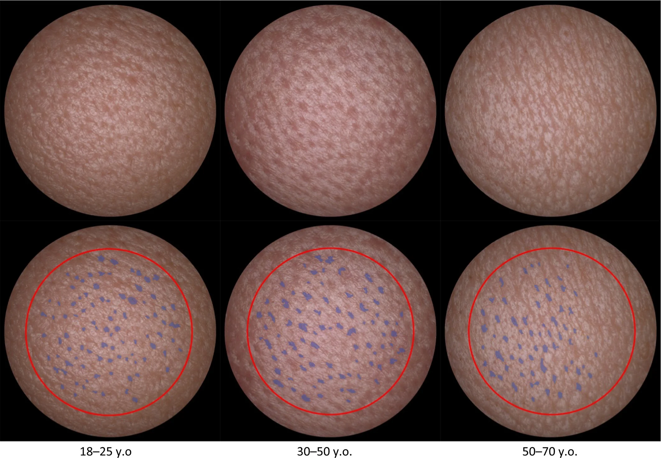 Pores become less ‘circular’ and more ‘elongated’ with increasing age (look at the shape of the blue dots) Source: Shaiek A, Flament F, et al. 2017, A new tool to quantify the geometrical characteristics of facial skin pores: changes with age and a making‐up procedure in Caucasian women, Skin Res Technol , 23(2):249-257.
