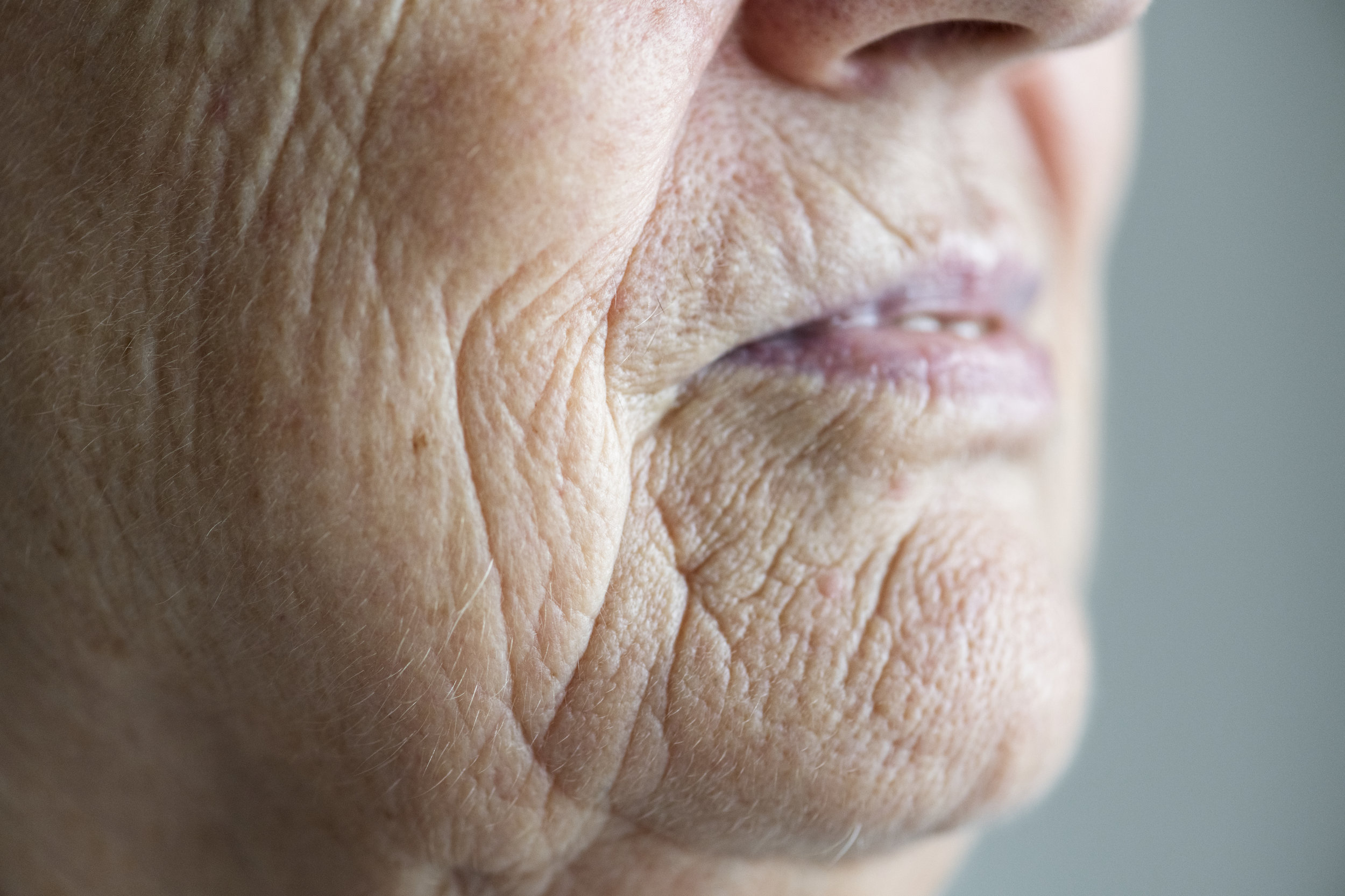 skin laxity and wrinkles.jpeg