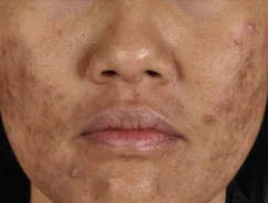 Source | Silpa-Archa N, Kohli, I, et al. 2017, J Am Acad Dermatol, 77(4):591-605