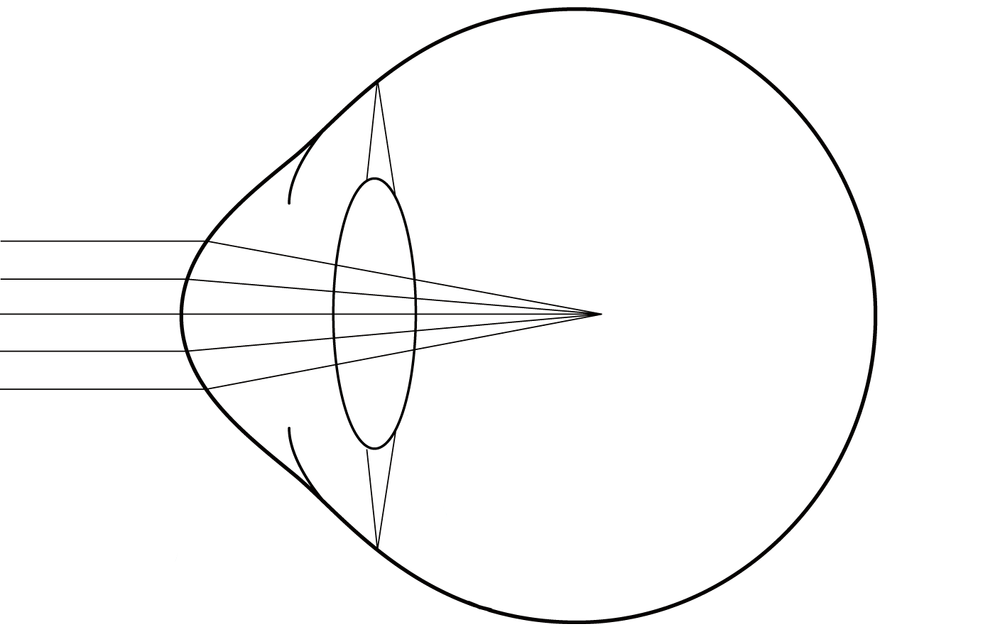 Lens Replacement Surgery — Kieren Darcy · Ophthalmologist · Vision