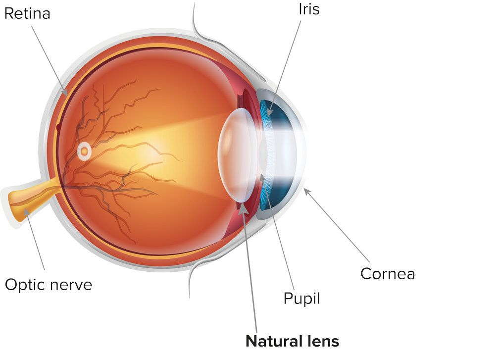 Lens Replacement Surgery — Kieren Darcy · Ophthalmologist · Vision