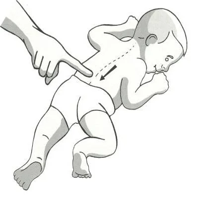 The Spinal Galant reflex position. Stroking down the side of the spine with a pen or a finger will cause someone with an active spinal galant to turn to the side that was stimulated, or to flinch or feel discomfort.