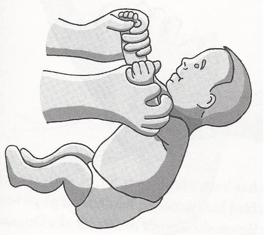 The Hands-Pulling reflex position.