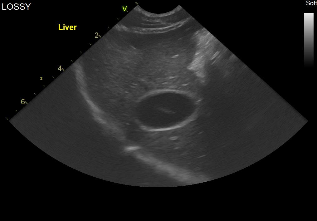 Liver Ultrasound.jpg