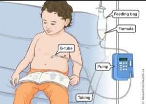 Hint What Is Used To Manage A Dislodged Feeding Tube Connected Care Sickkids