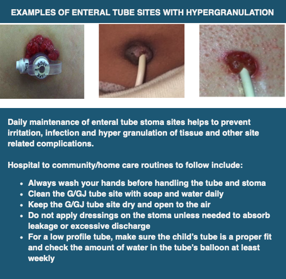 Hint How Do I Manage A Red And Swollen Enteral Tube Stoma Connected Care Sickkids