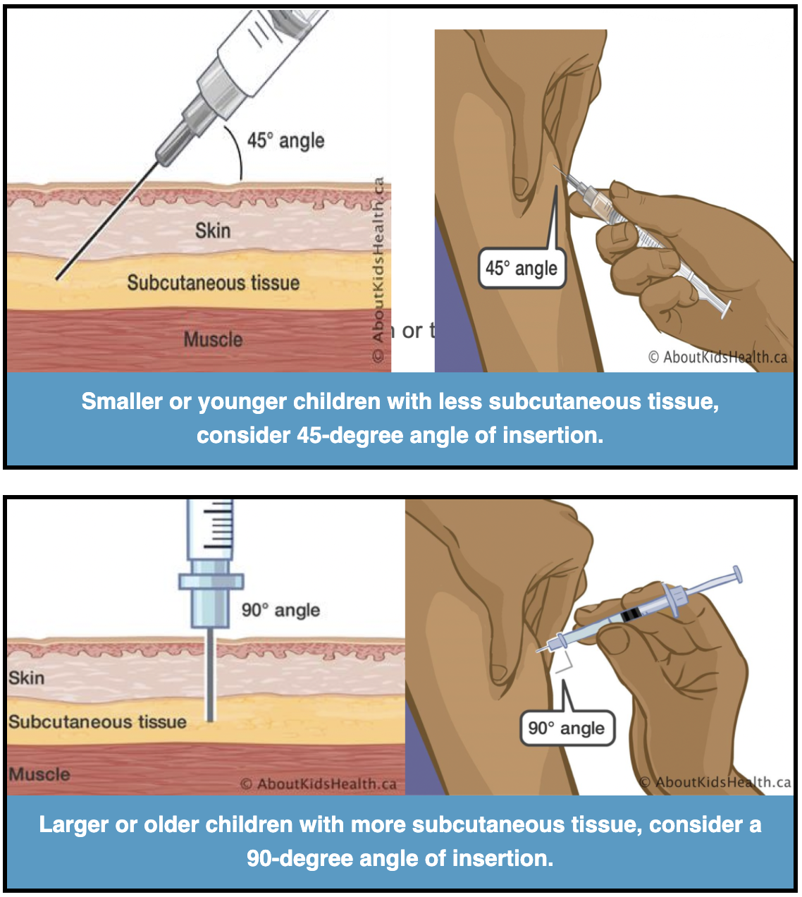 Max Sub Q Injection Volume | How To Give Yourself a Subcutaneous ...