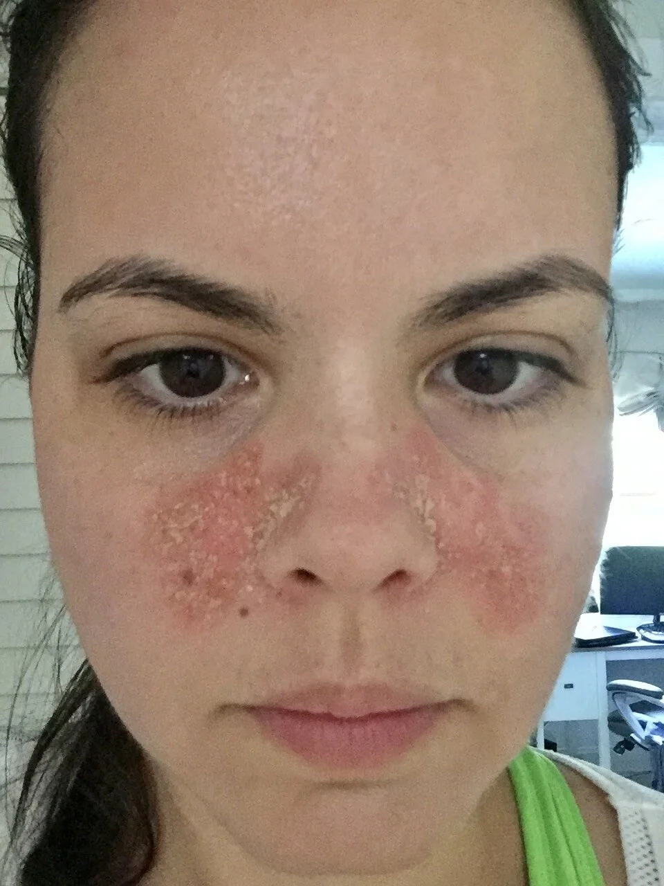 medical-medium-rosacea-flare-up.jpg