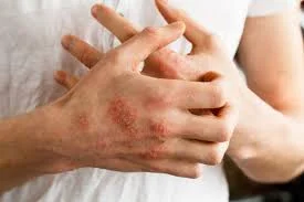 allergy treatment.jpeg
