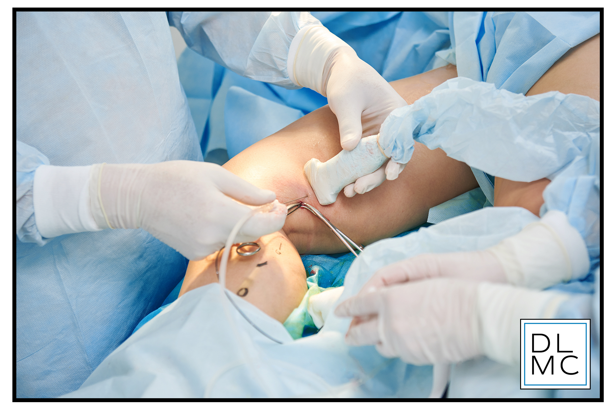 Sclerotherapy for Varicose and Spider Veins .jpg