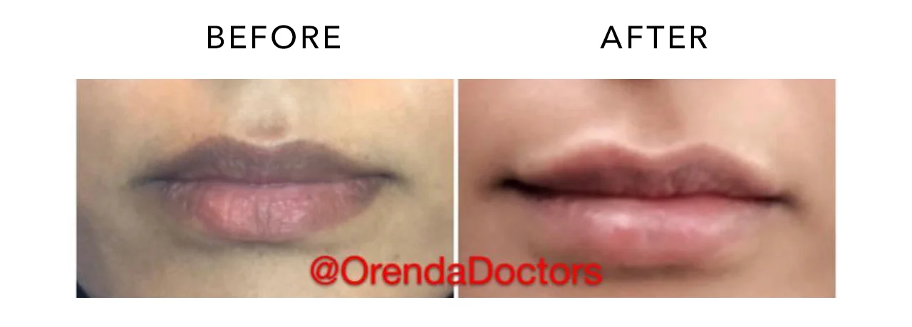 LIP FILLER KHADAVI.jpg