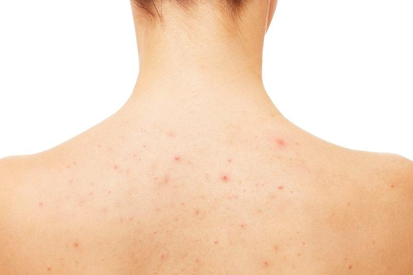 how_to_get_rid_of_back_acne_1024x1024.jpg
