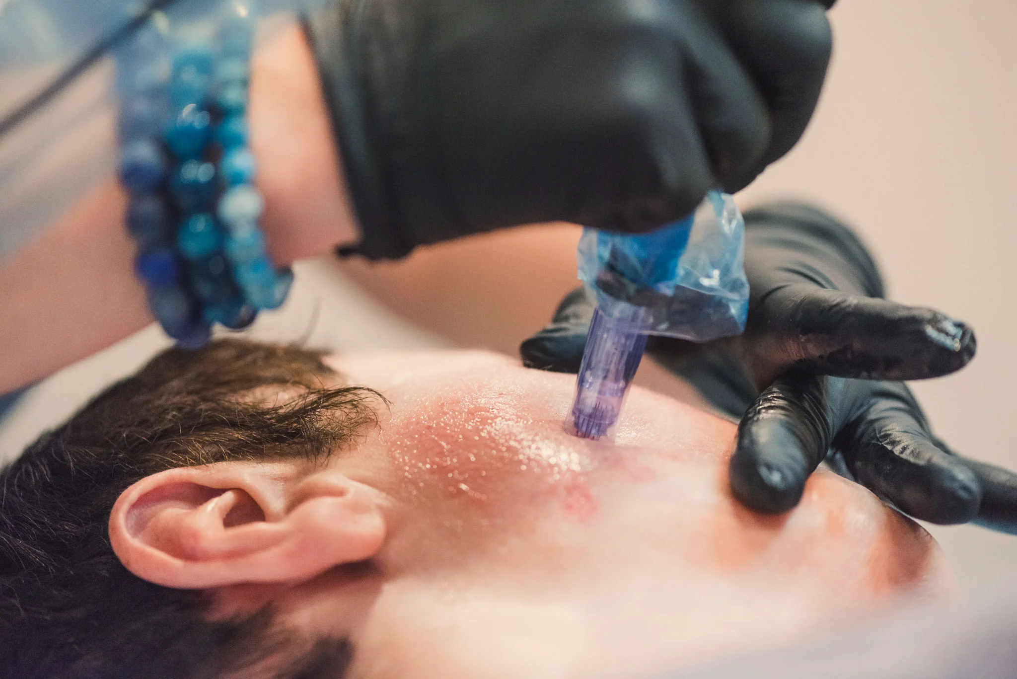microneedling.jpg