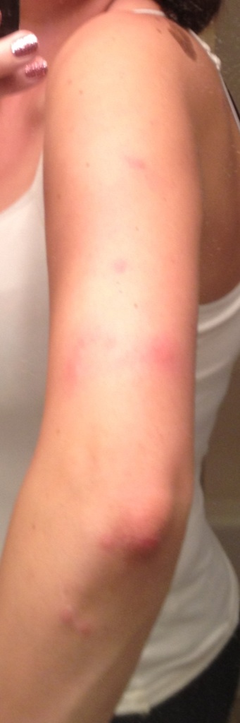 flash_bed_bug_bite.jpeg