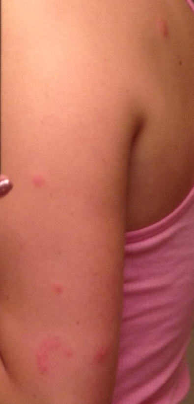 flash_bed_bug_bite2.jpeg