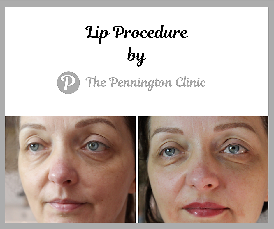 Lip Procedure by The Pennington Clinic.png