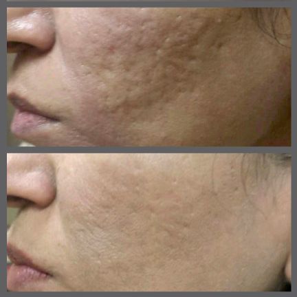 microneedling4.jpg