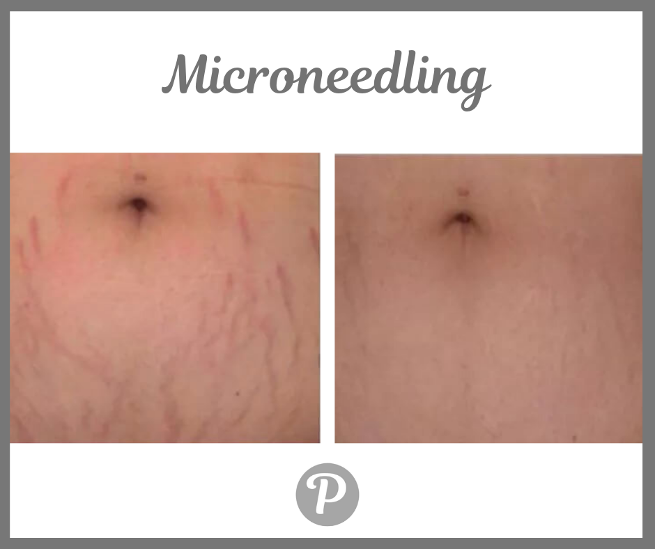 Microneedling (1).png