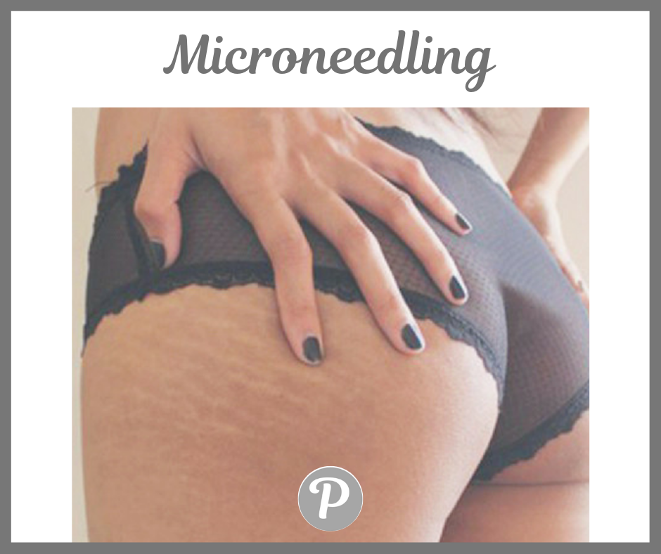 Microneedling (2).png