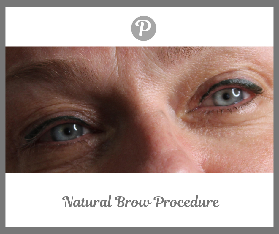 Natural Brow Procedure (1).png